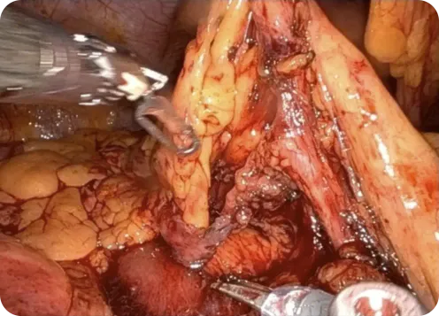 Endoscopic surgical image